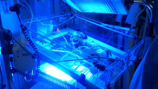 fototerapia de ictericia neonatal