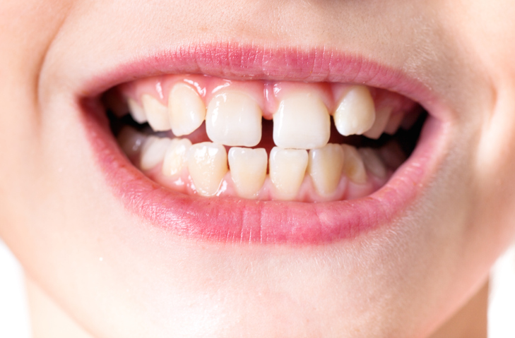 El Rechinamiento De Los Dientes En Niños - Healthychildren.Org