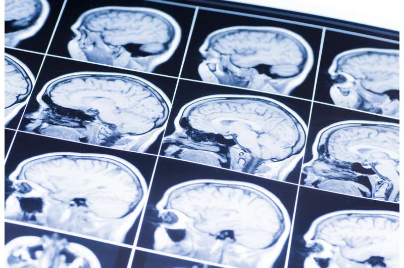 Las lesiones en la cabeza en los niños se relacionan con la reducción del tamaño del cerebro y las dificultades de aprendizaje